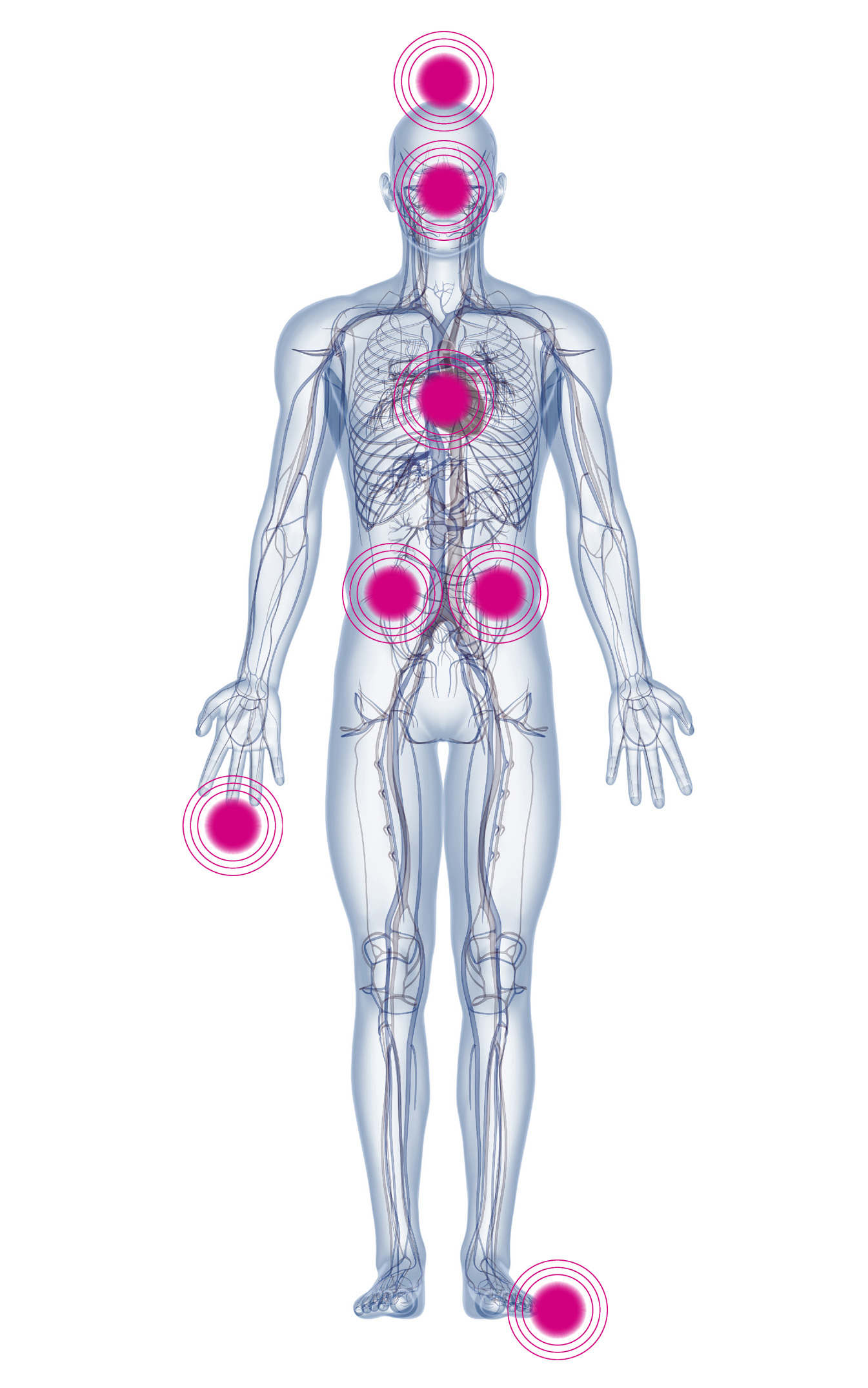 Schaubild: Folgeerkrankungen eines dauerhaft erhöhten Blutzuckers, menschlicher Körper mit Markierungen der betroffenen Bereiche